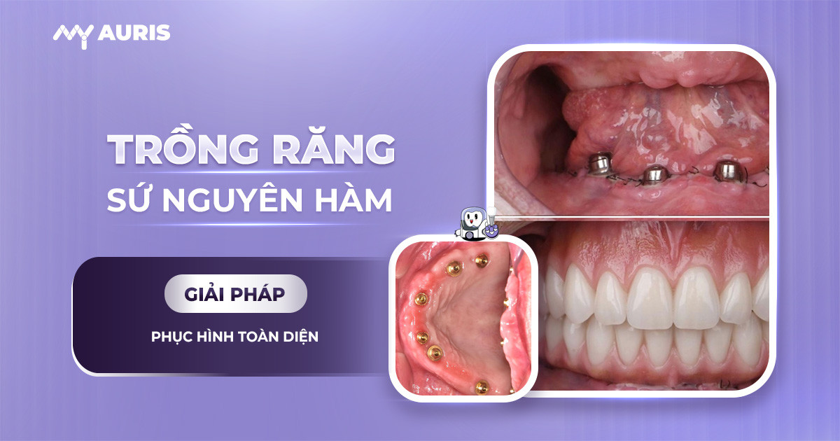 trong-rang-implant-nguyen-ham-061124-04