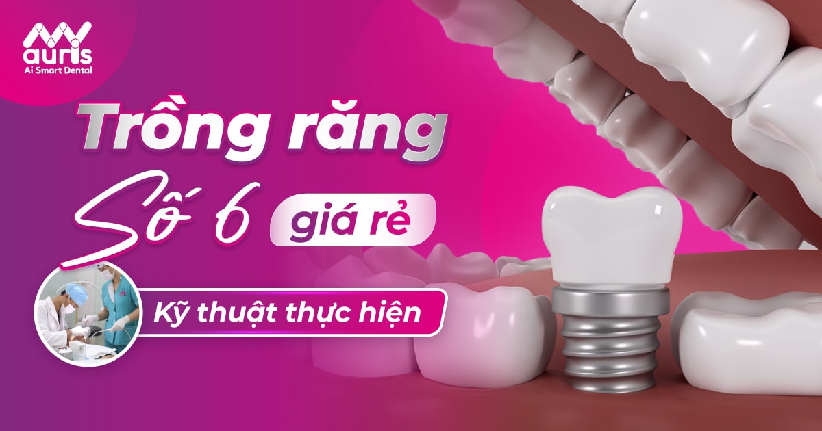 Trồng răng số 6 giá rẻ với kỹ thuật nào hiệu quả?