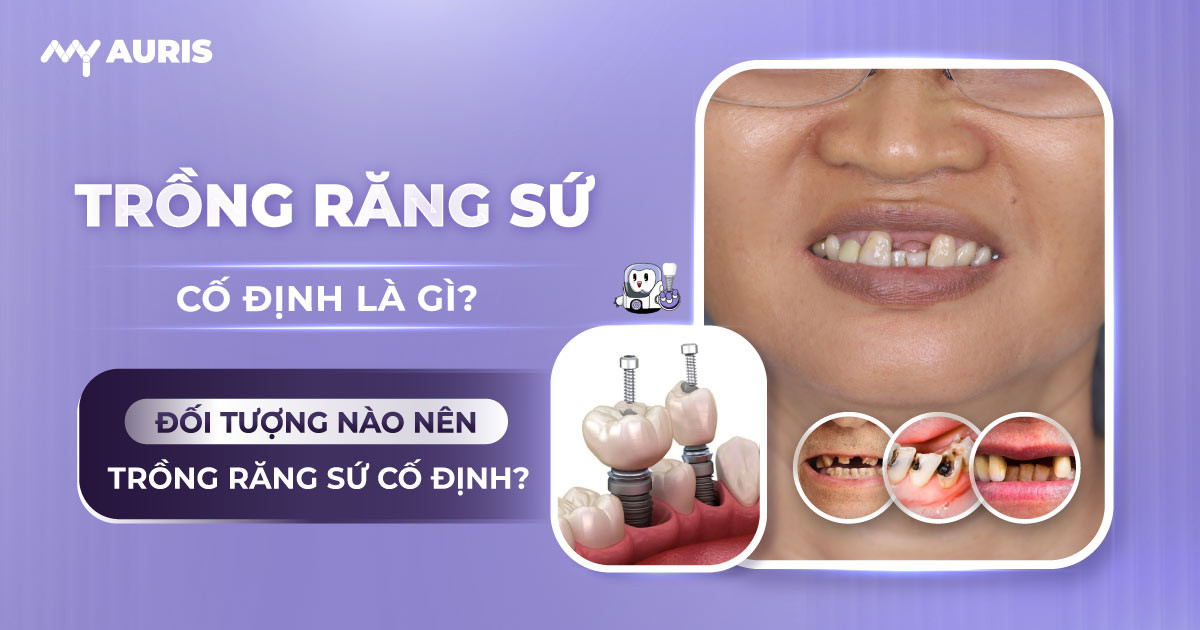 trồng răng sứ cố định