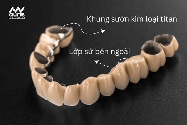Đặc điểm răng sứ titan 
