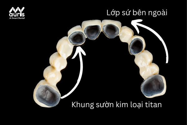 Các loại răng sứ titan