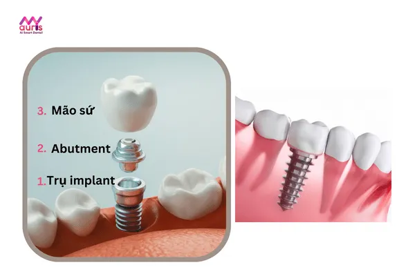 Đặc điểm của trồng răng bắt vít khác với trồng răng implant truyền thông 