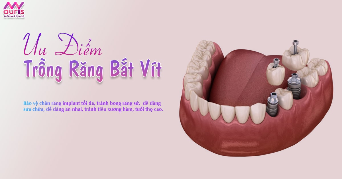 ưu điểm trồng răng bắt vít