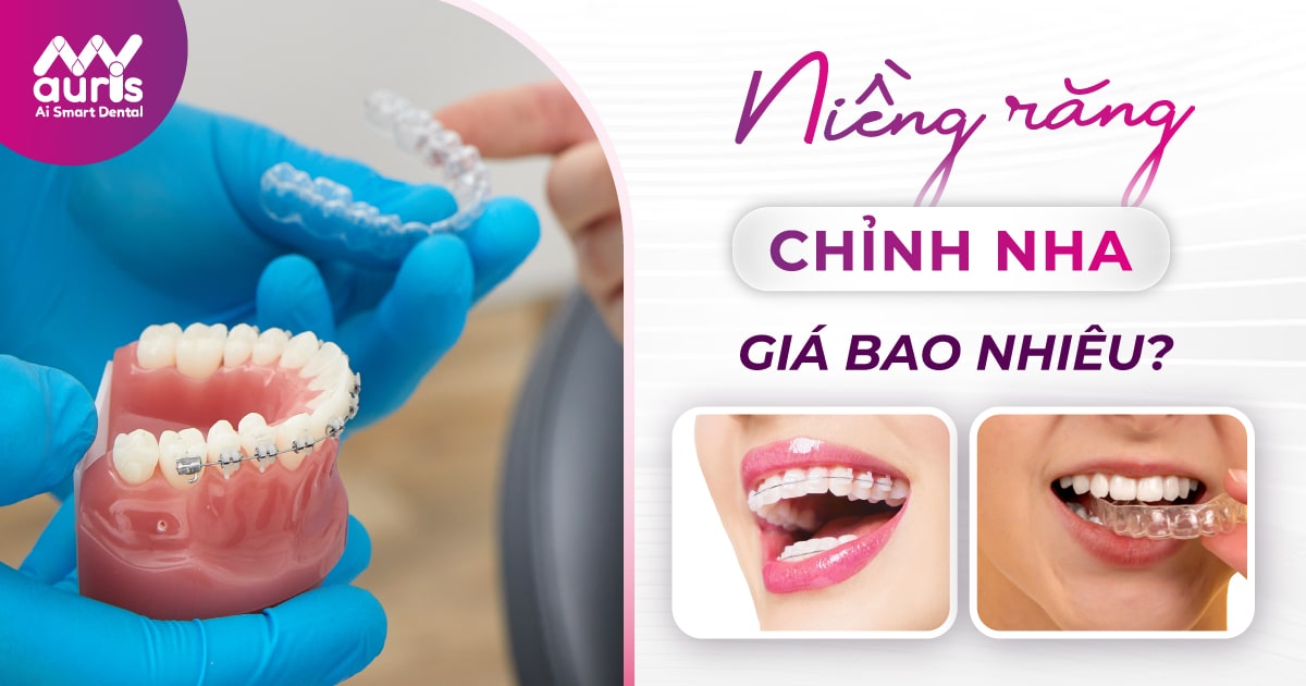 niềng răng giá bn