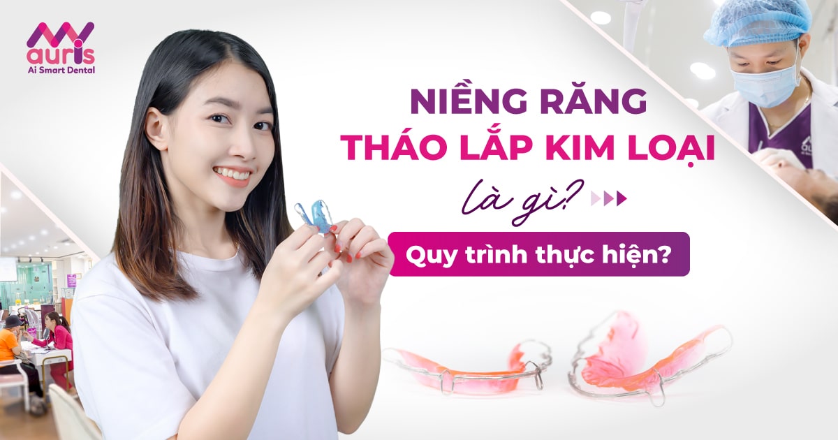 niềng răng tháo lắp bằng kim loại