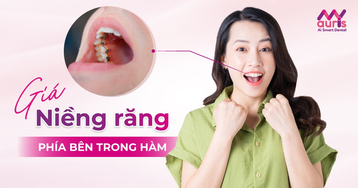 giá niềng răng phía bên trong hàm