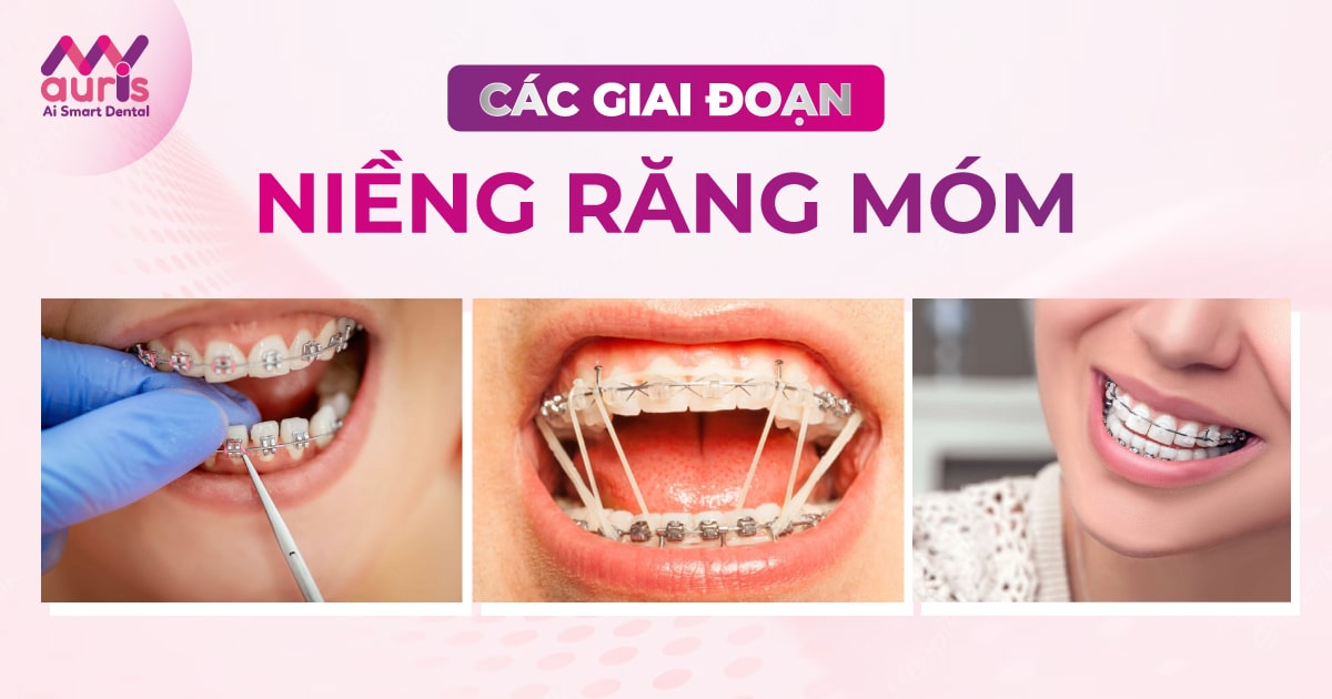 các giai đoạn của niềng răng móm