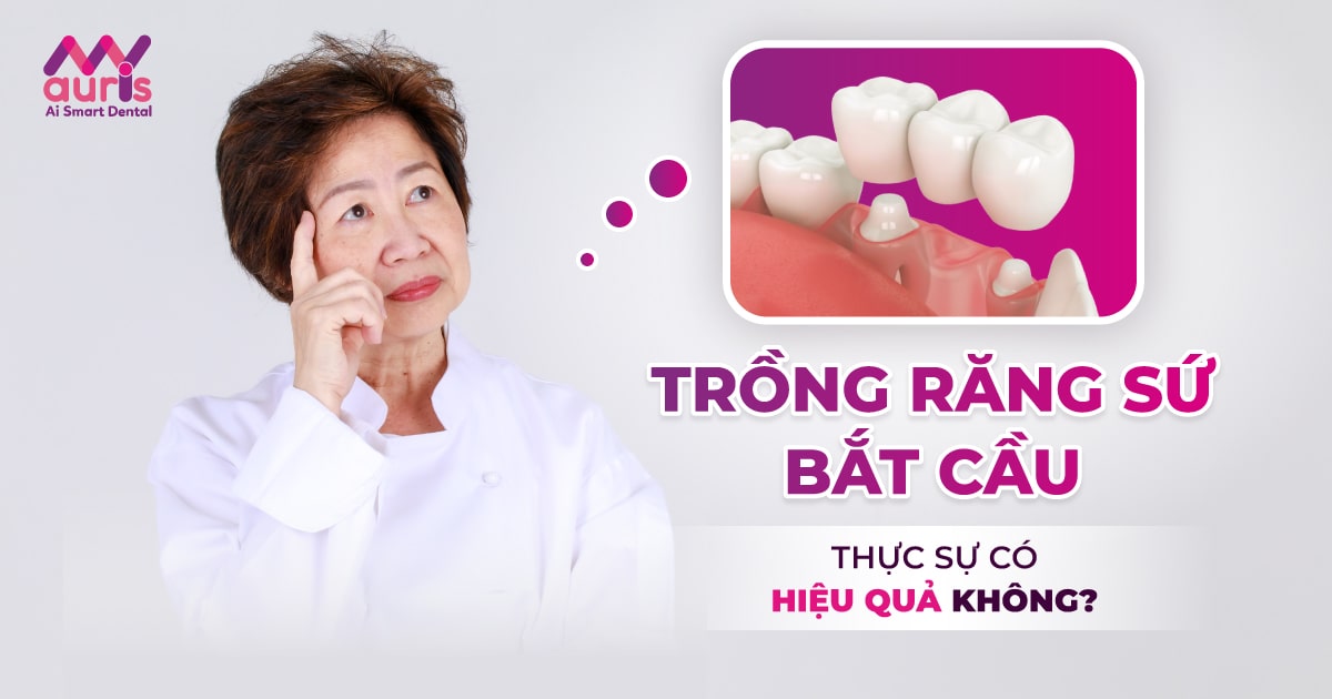 trồng răng sứ bắt cầu