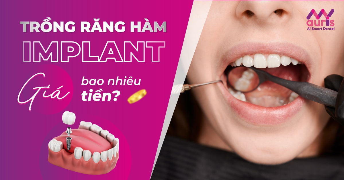 trồng răng hàm implant giá bao nhiêu