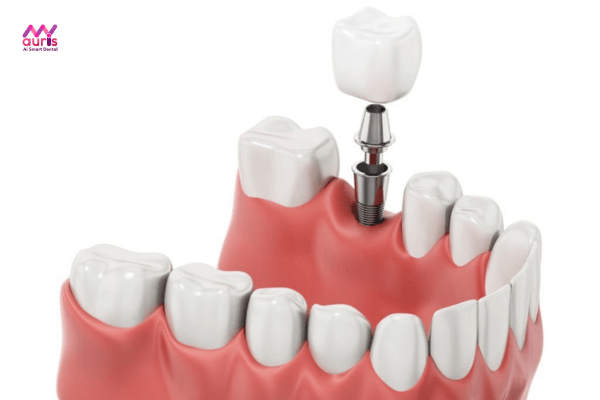 Trồng răng implant - Trồng răng hàm đau không?