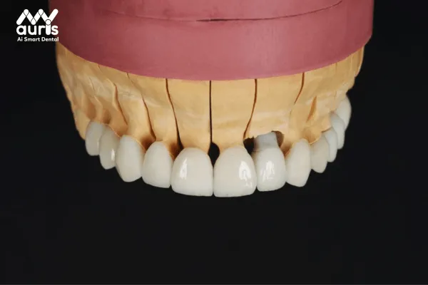 Bảng giá trồng răng hàm bằng cầu răng sứ