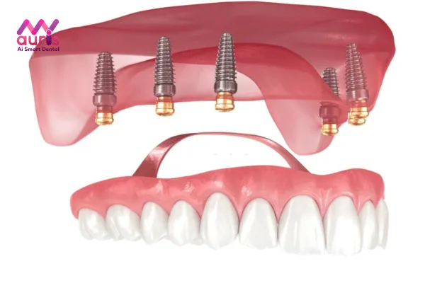 Trồng răng Implant với chi phí bao nhiêu?