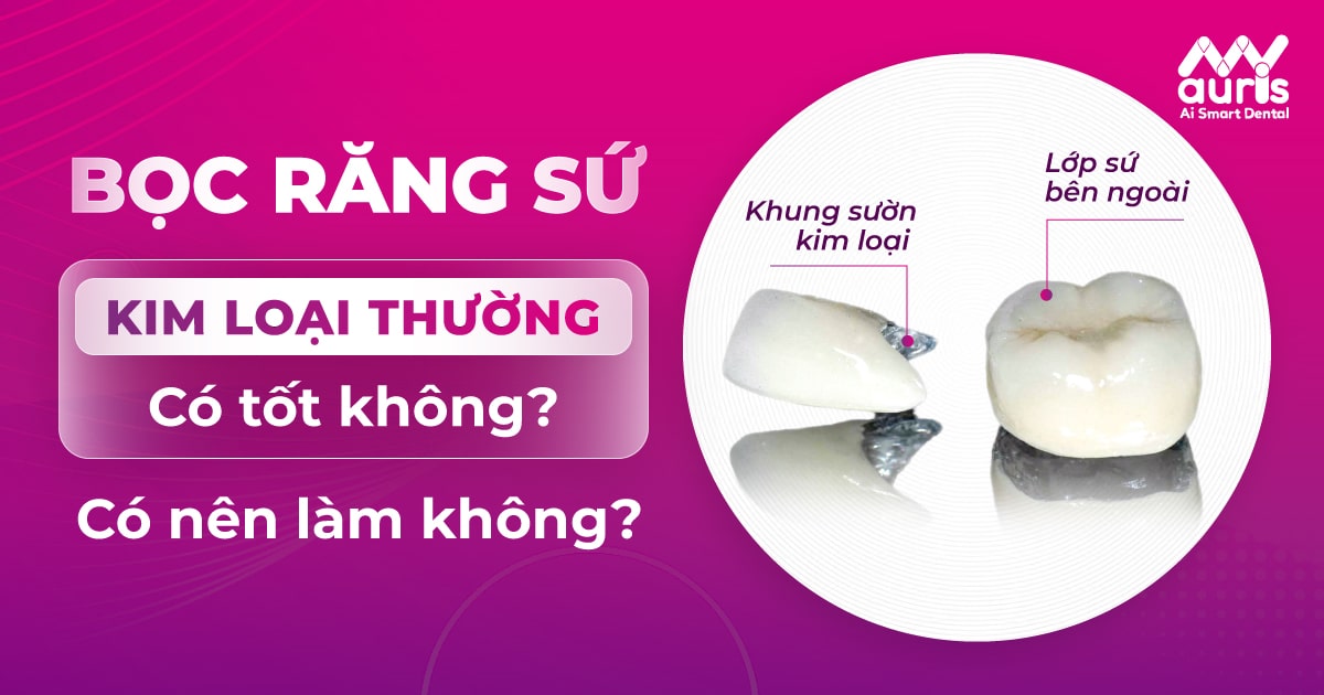 Bọc răng sứ kim loại thường có tốt không?