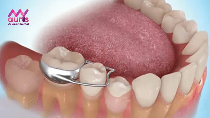 các giai đoạn của quá trình niềng răng hô