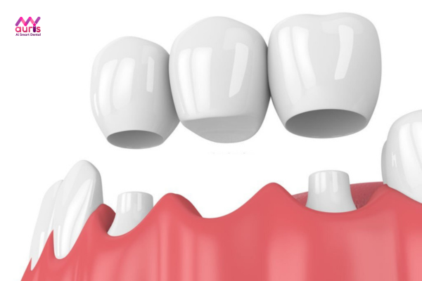 Các phương pháp trồng răng hàm - Cầu răng sứ 