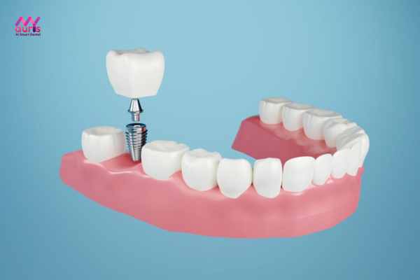 Trồng răng implant - Các phương pháp trồng răng hàm 