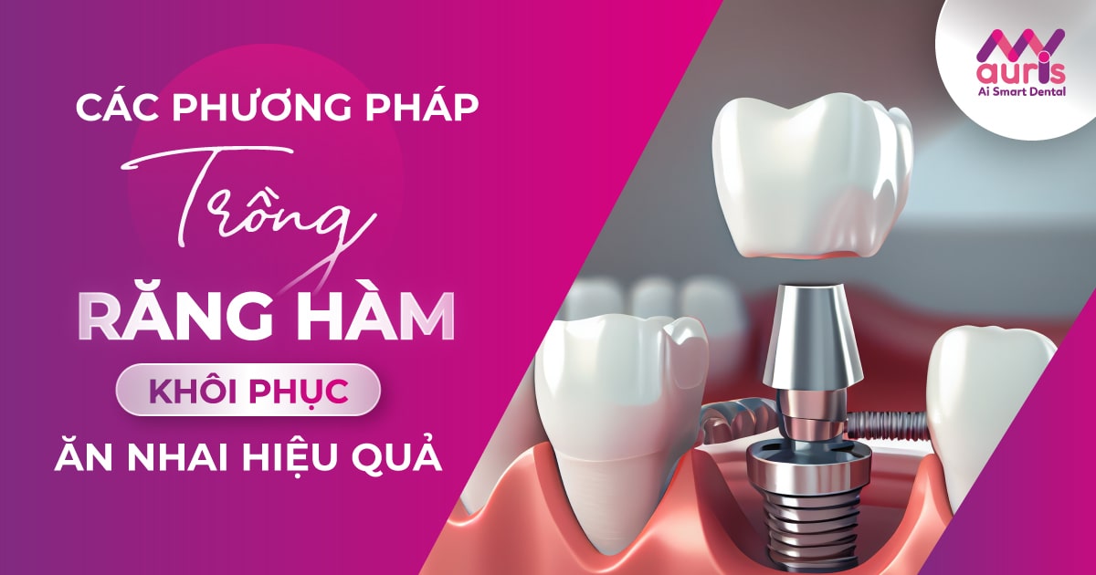 Các phương pháp trồng răng hàm