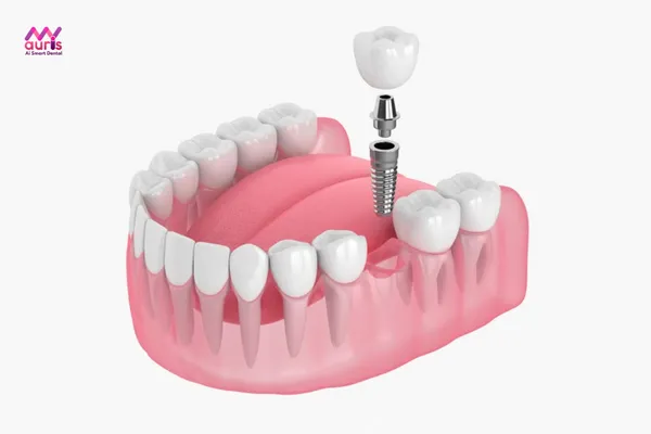 Trồng răng implant - Cách trồng răng hàm trên 