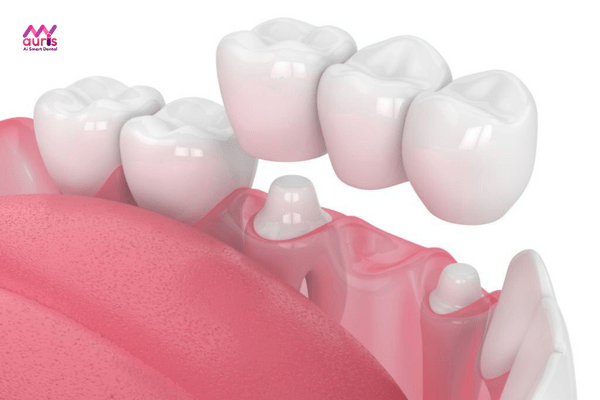 Cầu răng sứ - Cách trồng răng hàm trên