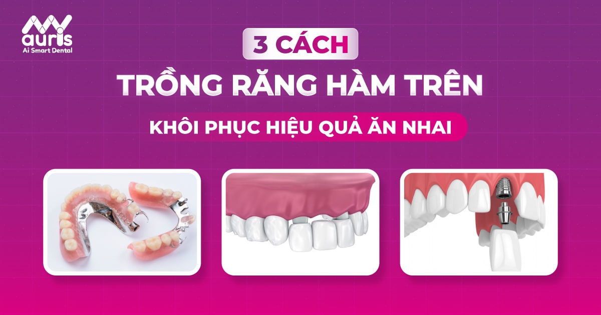 cách trồng răng hàm trên