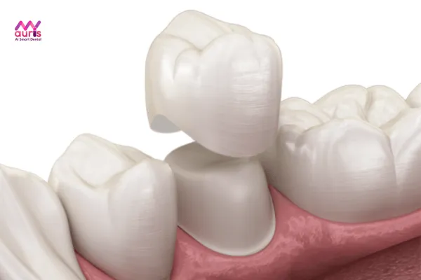 Bọc răng sứ - Trồng răng khểnh tại nha khoa