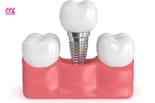 Trồng răng implant - Trồng răng khểnh tại nha khoa 