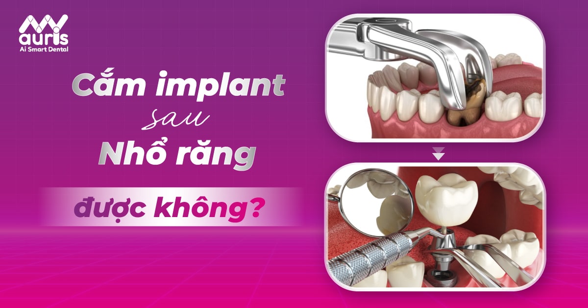 [Hỏi đáp] Cắm Implant sau nhổ răng liền được không?