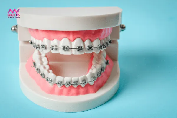 Tìm hiểu các phương pháp niềng răng trước khi niềng răng 