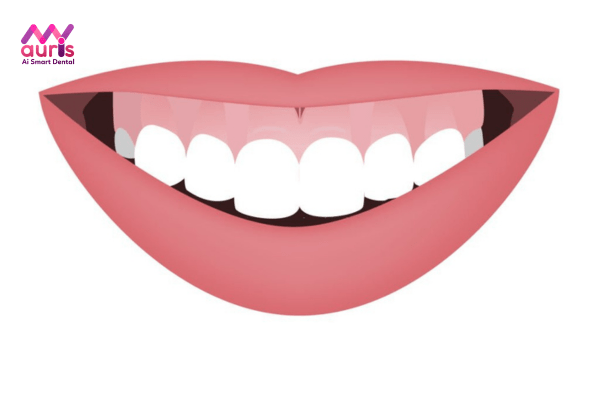 Cười hở lợi có niềng răng được không? Giải đáp nha khoa
