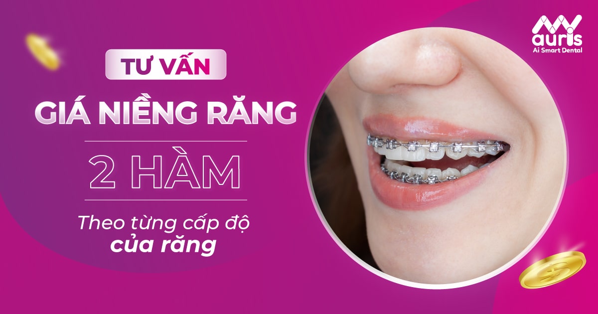 giá niềng răng 2 hàm