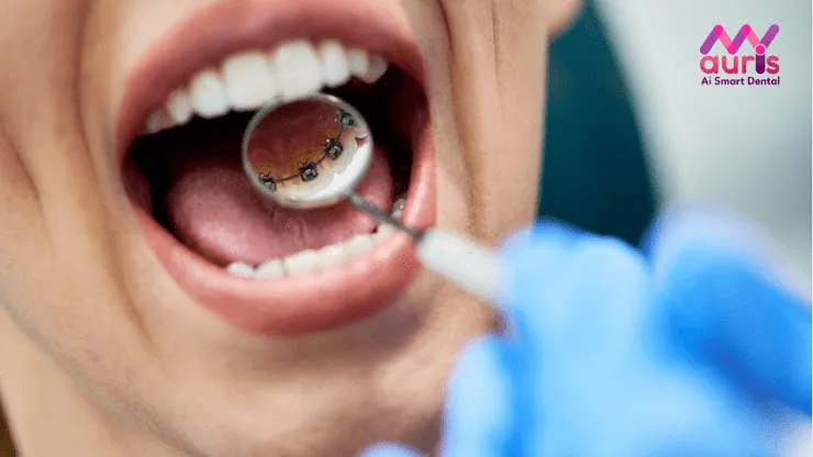 giá niềng răng phía bên trong hàm