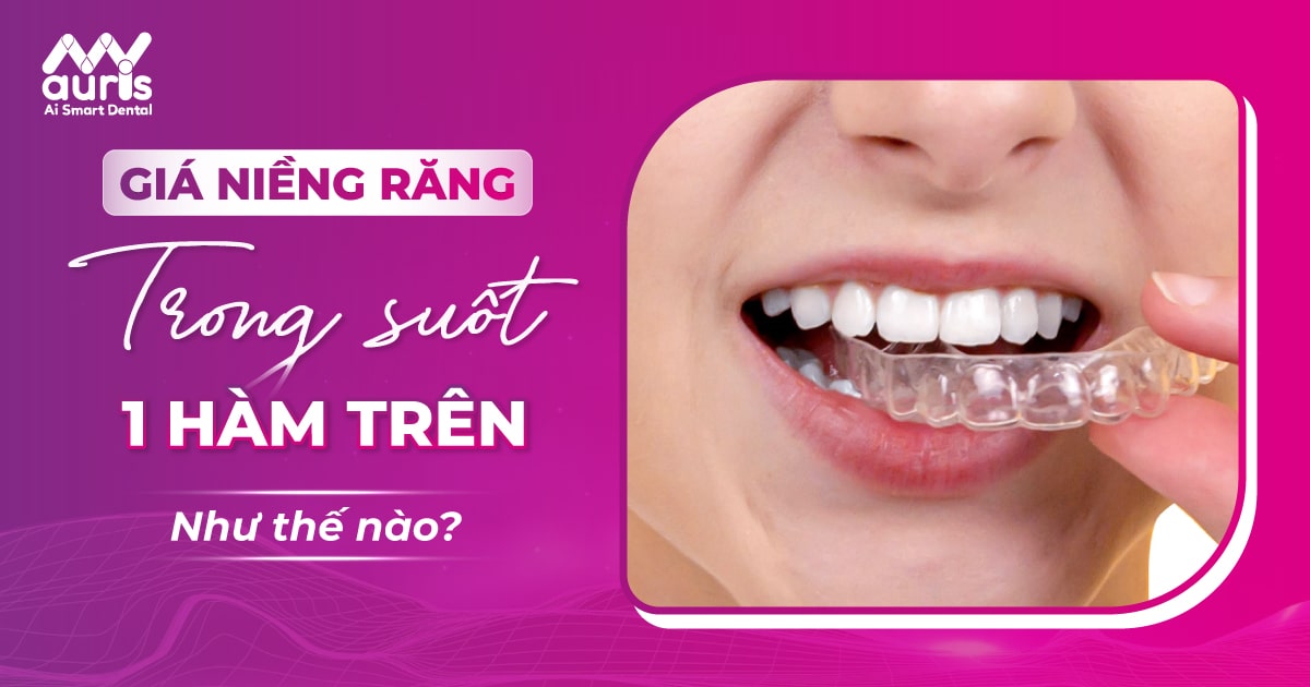 Giá niềng răng trong suốt 1 hàm trên như thế nào?