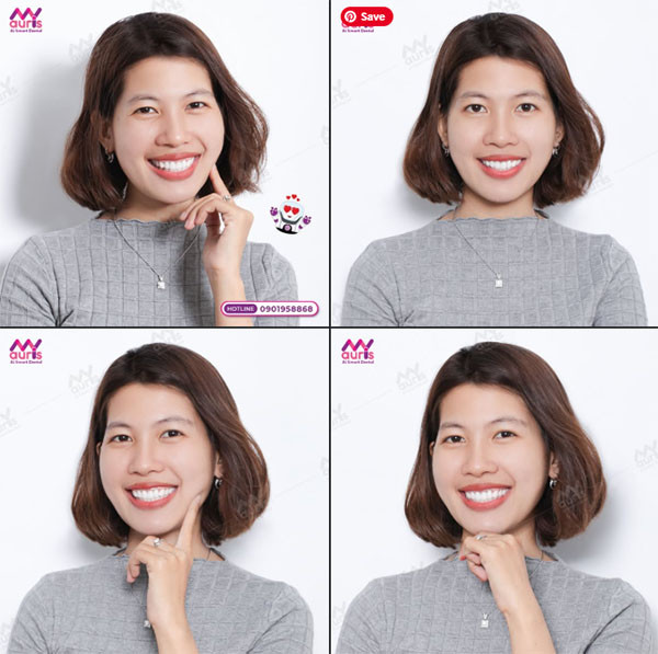 bảng giá răng sứ ht smile,giá răng sứ ht smile,răng sứ ht smile giá bao nhiêu