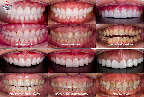 bảng giá răng sứ ht smile,giá răng sứ ht smile,răng sứ ht smile giá bao nhiêu
