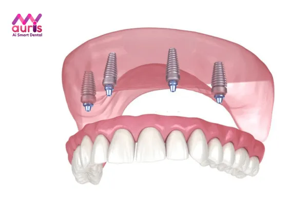 Các yếu tố ảnh hưởng đến chi phí trồng răng Implant