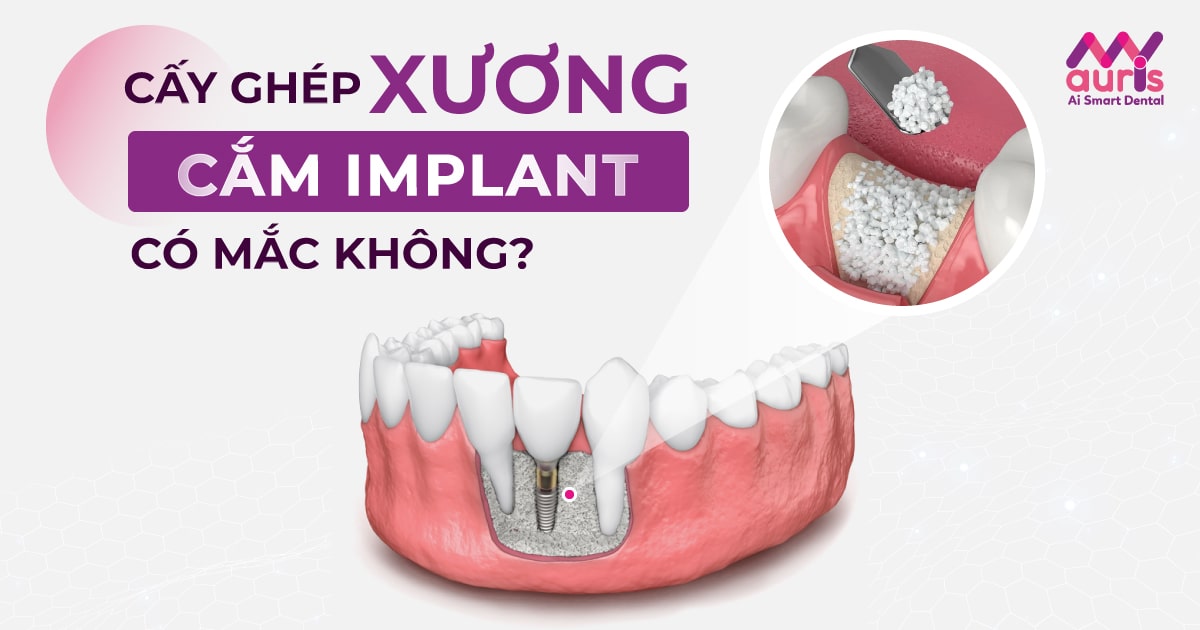 [Hỏi đáp] Cấy ghép xương để cắm Implant có MẮC không?