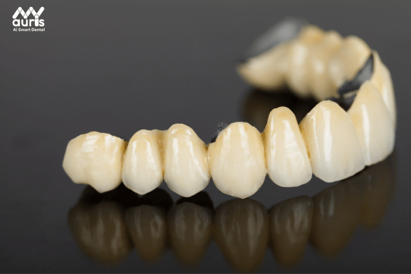 Răng sứ kim loại 
