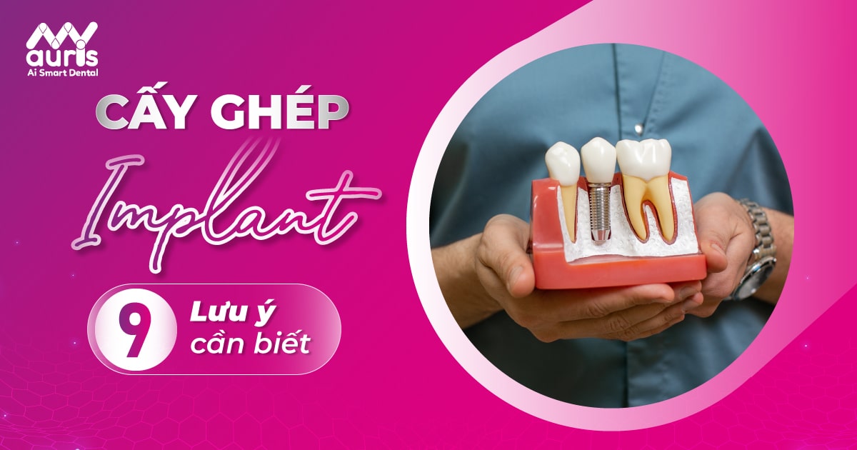 9 Lưu ý khi cấy ghép Implant cần quan tâm