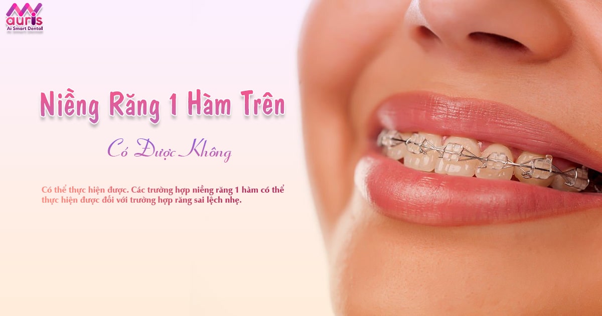 niềng răng 1 hàm trên có được không