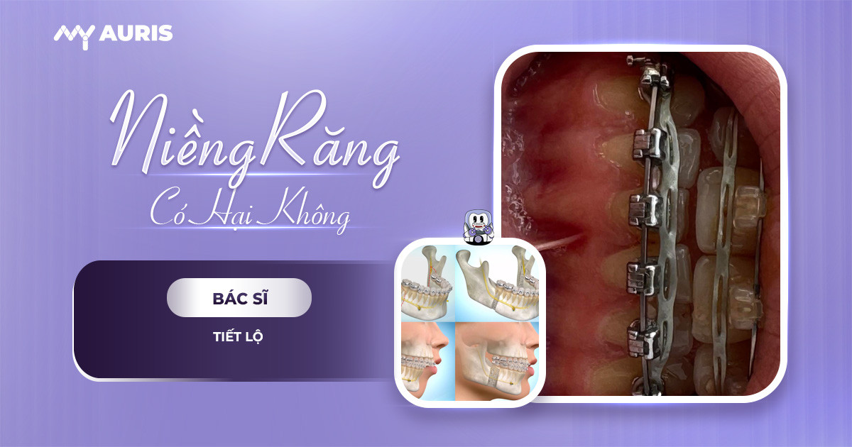 niềng răng có hại không,niềng răng có tác hại gì,niềng răng tác dụng,niềng răng tác hại,niềng răng có tác hại gì không,lợi ích và tác hại của niềng răng,niềng răng có hại cho sức khỏe không