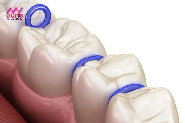 Đặt thun tách kẽ răng, gắn mắc cài là các giai đoạn gây khó chịu nhất trên cung hàm