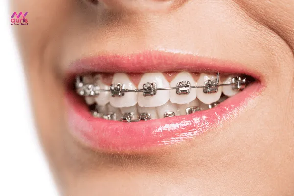 Niềng răng mắc cài kim loại tự đóng là gì? 