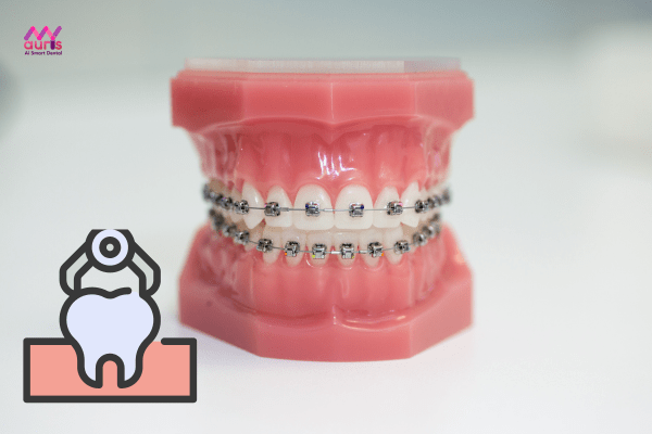 Niềng răng mắc cài kim loại tự đóng có cần nhổ răng không? 