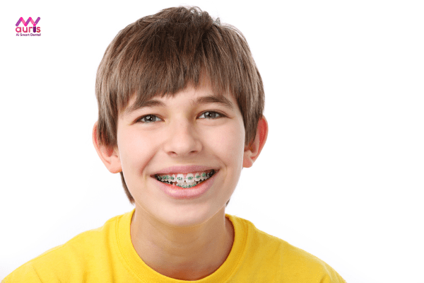 Mức độ lệch lạc của răng cũng quyết định đến chi phí niềng răng 
