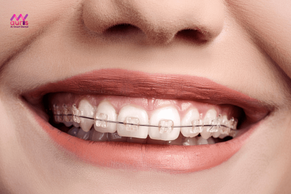 Như thế nào là niềng răng mắc cài sứ thường?