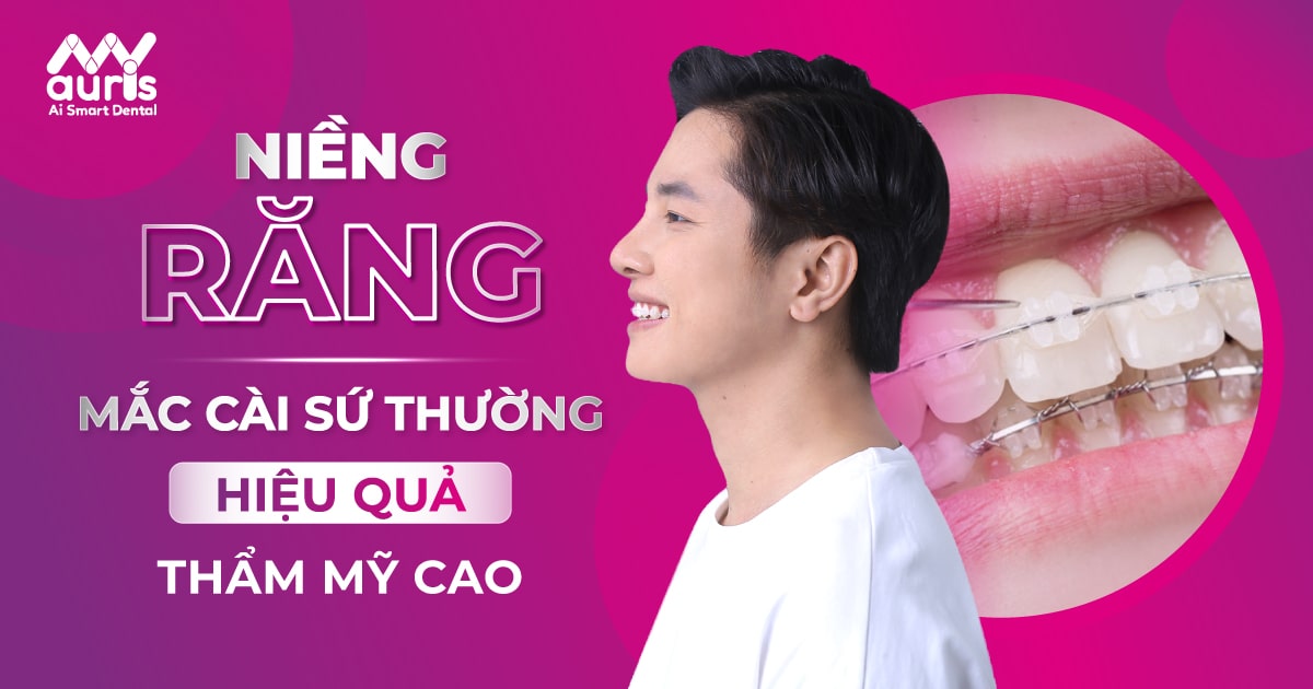 Niềng răng mắc cài sứ thường