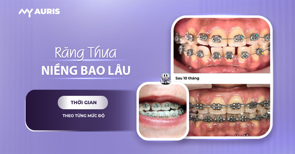 niềng răng thưa mất bao lâu, răng thưa có niềng được không