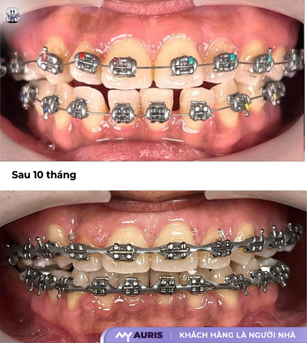 niềng răng thưa mất bao lâu, răng thưa có niềng được không