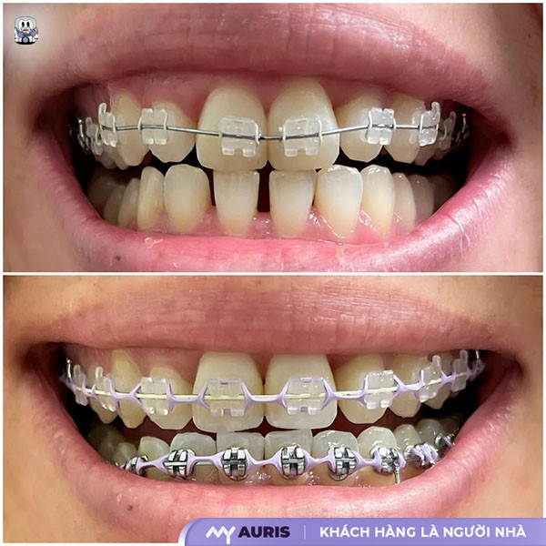 niềng răng thưa mất bao lâu, răng thưa có niềng được không