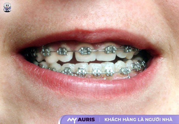 niềng răng thưa mất bao lâu, răng thưa có niềng được không